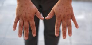 Men’s,Hands,Showing,Rash,Due,To,Pox,Viral,Infection,Painful